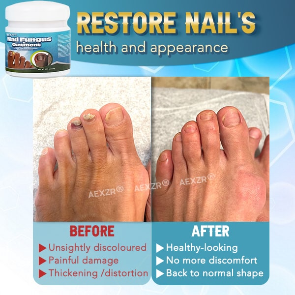 Aexzr® 5X Quick-healing Nail Fungus Ointment